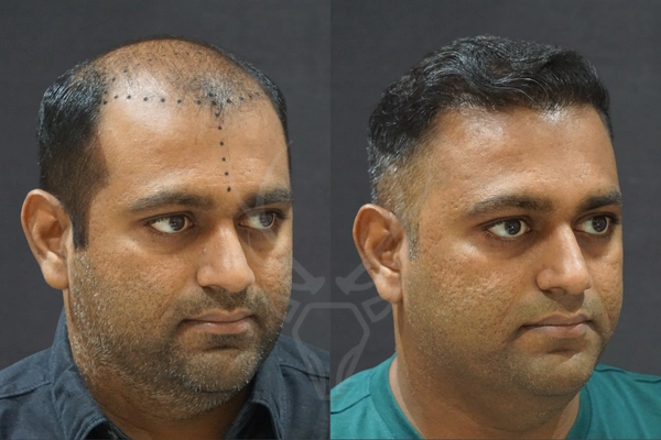 Musk Clinic Hair Transplant Results Before After Results (Left)