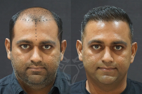 Musk Clinic Hair Transplant Results Before After Results (Middle)