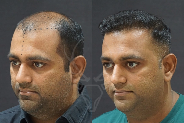 Musk Clinic Hair Transplant Results Before After Results (Right)