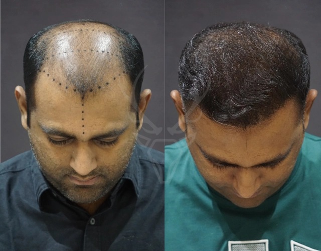 Musk Clinic Hair Transplant Results Before After Results 44