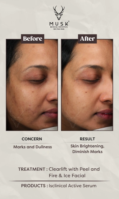 Shirney - Clearlift with Peel and Fire Ice Facial (Skin Treatment Before After Results)