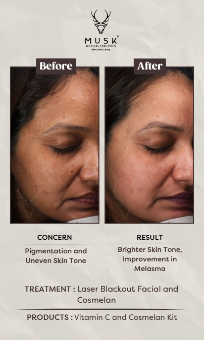 Upadhya Jigna - Laser Blackout Facial and Cosmelan (Skin Treatment Before After Results)