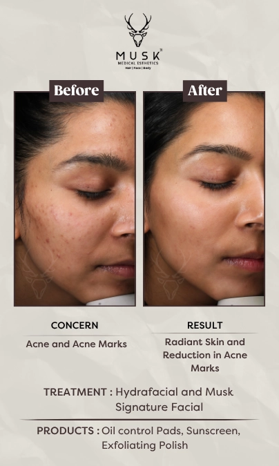 Richa (Peels, Laser blackout) Skin Treatment Before After Results