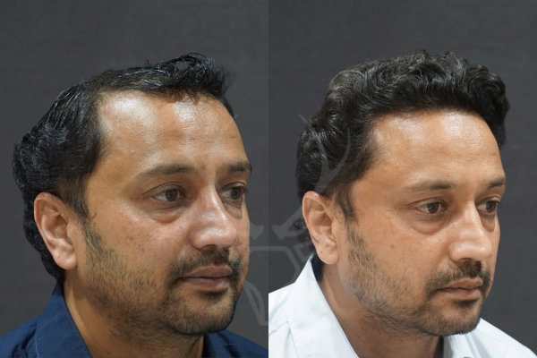 Musk Clinic Hair Transplant Results Before After Results (Left)