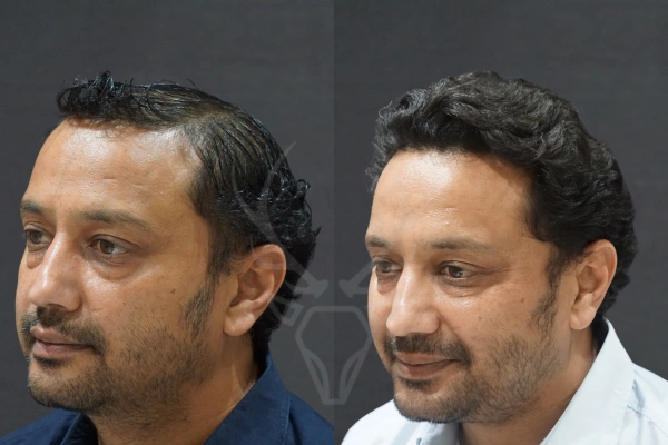 Musk Clinic Hair Transplant Results Before After Results (Right)