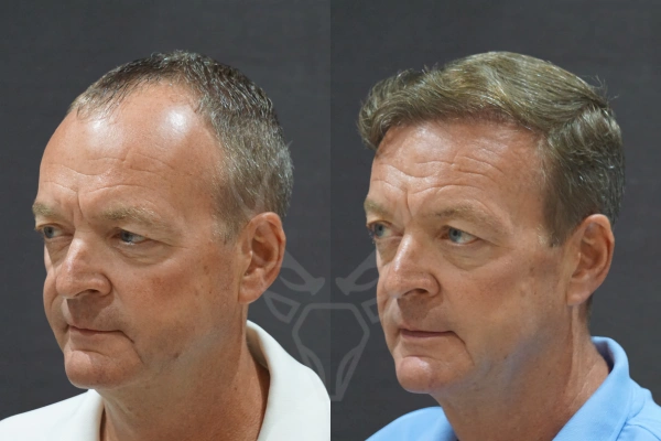 Musk Clinic Hair Transplant Before-After Results 45 (Right)