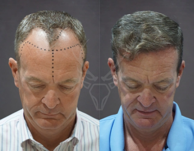Musk Clinic Hair Transplant Before-After Results 45