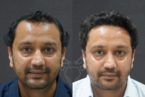 Musk Clinic Hair Transplant Results Before After Results (Middle)