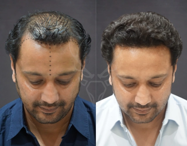Musk Clinic Hair Transplant Before-After Results 46
