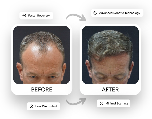 Paul Collerary Hair Transplant Before After