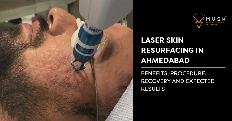 Laser Skin Resurfacing in Ahmedabad: Complete Guide