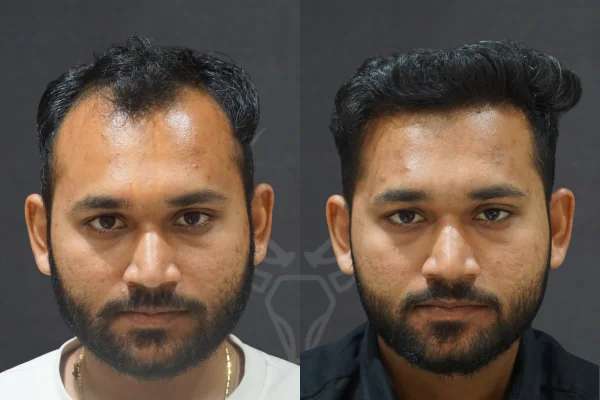 Musk Clinic Hair Transplant Results Before After Results (Middle)