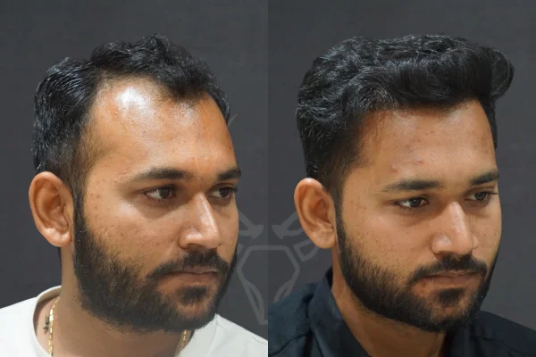 Musk Clinic Hair Transplant Results Before After Results (Left)
