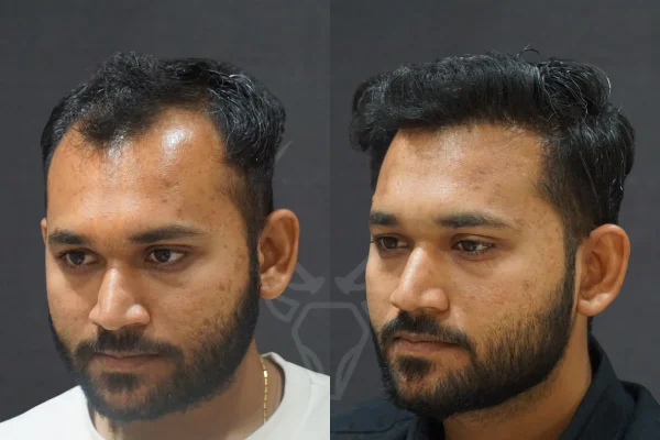 Musk Clinic Hair Transplant Results Before After Results (Right)