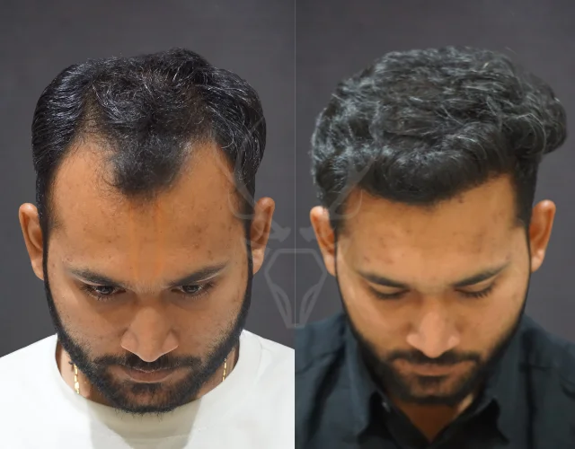 Musk Clinic Hair Transplant Before-After Results 46