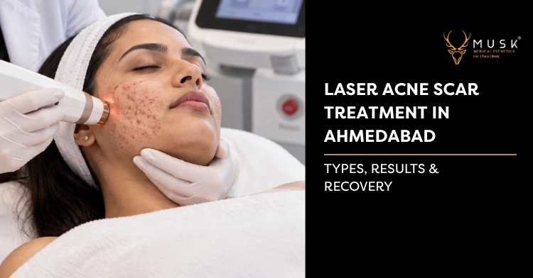 Laser Acne Scar Treatment in Ahmedabad: Types & Results
