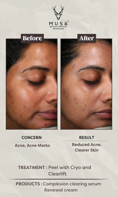Shivani (Peel with Cryo and Clearlift) Skin Treatment Before After Results